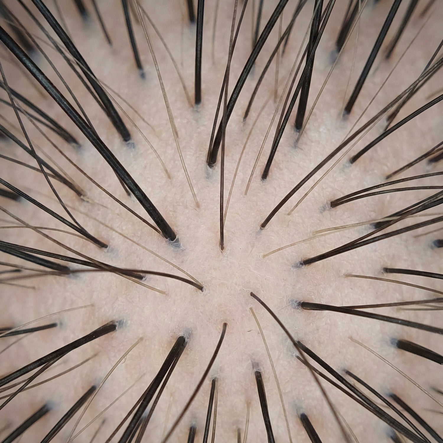 Dermatoscopisch beeld met variatie in haarschachtdiameter (anisotrichose), kenmerkend voor folliculaire miniaturisatie bij alopecia androgenetica.