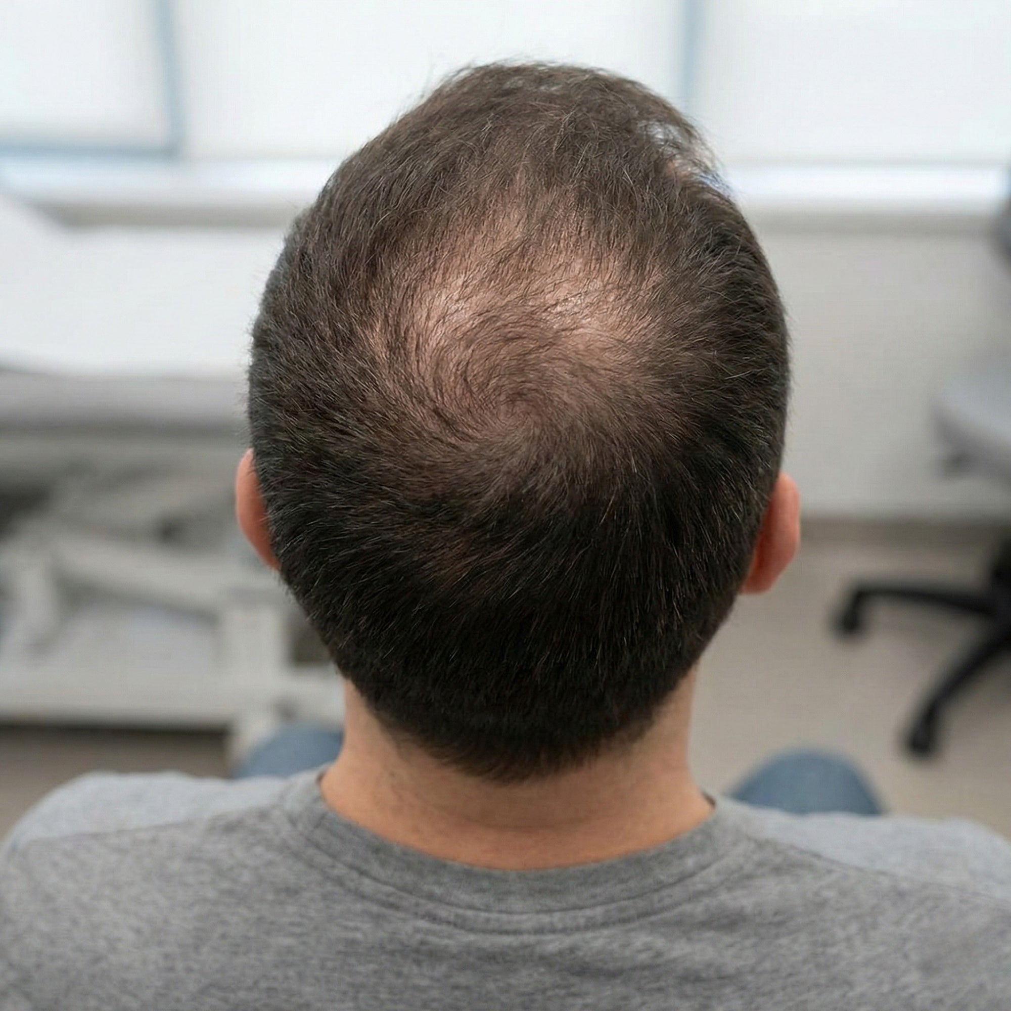 Afbeelding van alopecia androgenetica met haarverdunning op de kruin bij een man